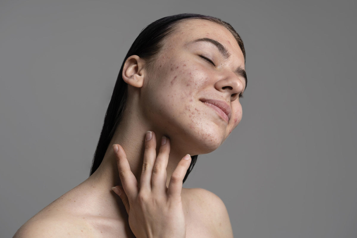 Close-up of a face with congested, blemish-prone skin along the cheek and jaw