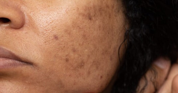 Close-up of a cheek showing dark spots and uneven pigmentation
